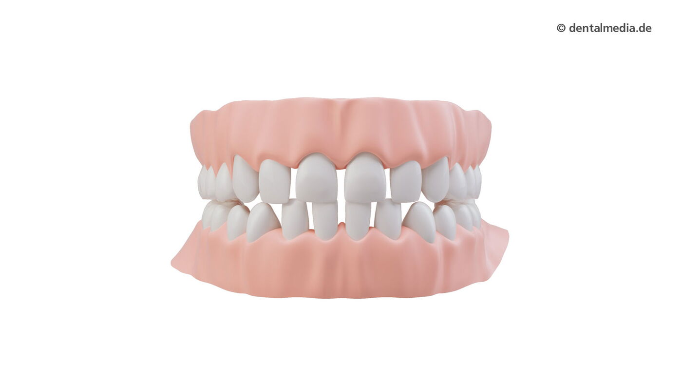 Mit der unsichtbaren Zahnschiene JOLA Aligner Zahnlücken schließen